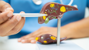 Alcoholic vs. Non-Alcoholic Fatty Liver Disease: Which Poses a Greater Threat?