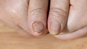 Fragile Nails: More Than Just a Cosmetic Issue? Underlying Health Conditions and What They Reveal
