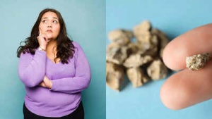 Obesity's Hidden Threat: How Excess Weight Fuels Kidney Stone Formation and What You Can Do
